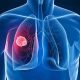 Akciğer kanserinin belirtileri nedir? Akciğer kanseri nasıl anlaşılır?