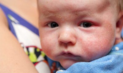 Bebeklerde görülen atopik dermatitin 8 belirtisi