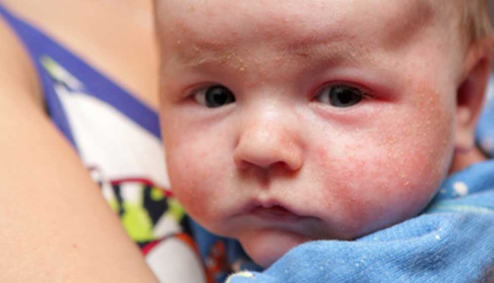 Bebeklerde görülen atopik dermatitin 8 belirtisi