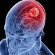 Beyin Kanseri nedir? Beyin Kanseri belirtileri nelerdir?