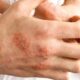 Uzmanlarından 'Egzama, besin alerjisi ile bağlantılı olabilir" tespiti