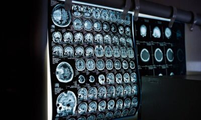 Pandeminin korkutan etkisi 'beyin sisi'